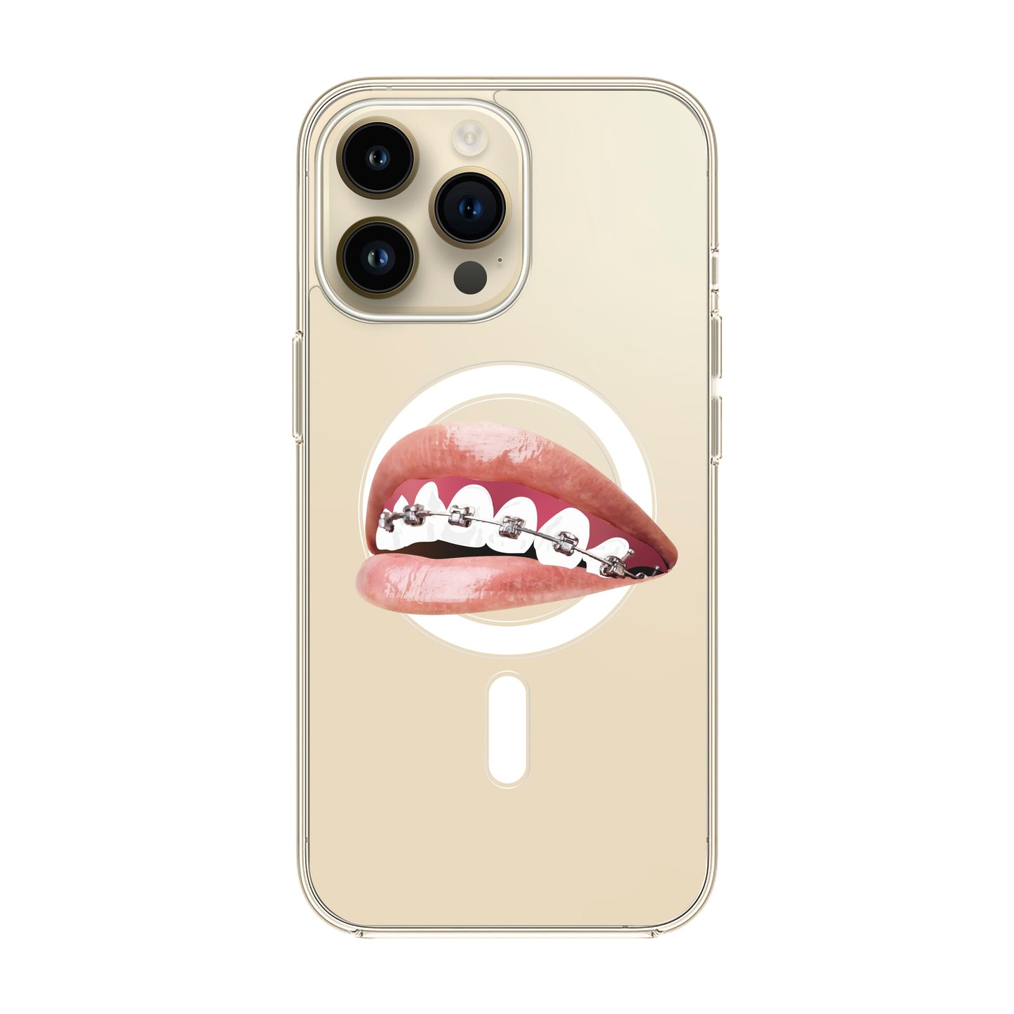ORTHODONTIST-iPhone 14 Pro Max Solid Kılıf MagSafe Özellikli