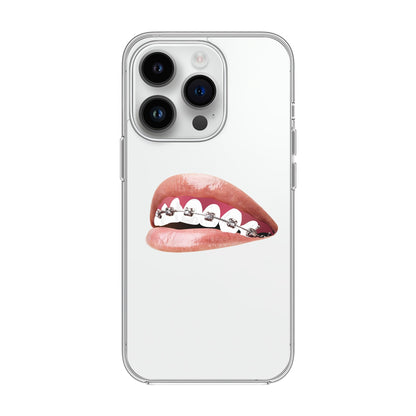 ORTHODONTIST-iPhone 14 Pro Solid Kılıf