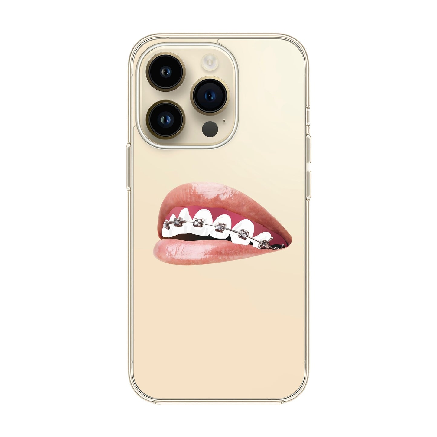 ORTHODONTIST-iPhone 14 Pro Solid Kılıf